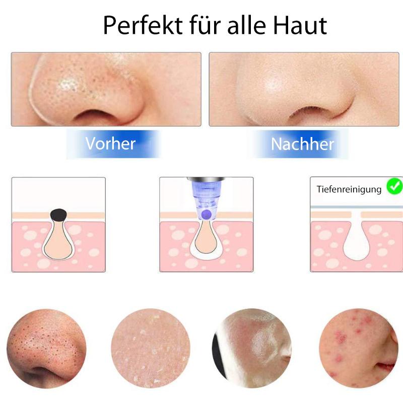 Mitesserentferner und Hautreiniger